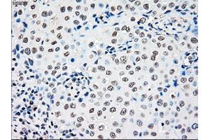 Immunohistochemical staining of paraffin-embedded Adenocarcinoma of colon tissue using anti-RAD9Amouse monoclonal antibody. (RAD9A anticorps)
