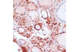Immunohistochemistry of paraffin-embedded human thyroid cancer using S100 antibody (ABIN7270126) at dilution of 1:100 (40x lens). (S100A5 anticorps  (AA 1-92))