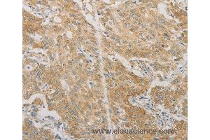 Immunohistochemistry of Human gastric cancer using ACSL4 Polyclonal Antibody at dilution of 1:60 (ACSL4 anticorps)
