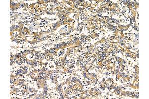 ABIN7095945 and ABIN7100007 at 1/100 staining human colorectal cancer by IHC-P.