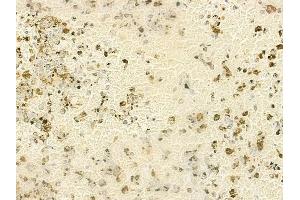 ABIN6265046 and ABIN6272880 at 1/100 staining human melanoma by IHC-P.