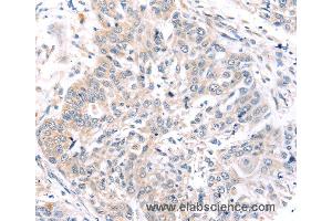 Immunohistochemistry of Human prostate cancer using ROR1 Polyclonal Antibody at dilution of 1:45 (ROR1 anticorps)