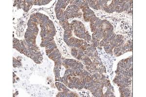 IHC-P Image Immunohistochemical analysis of paraffin-embedded human gastric cancer, using survivin , antibody at 1:100 dilution. (Survivin anticorps  (C-Term))