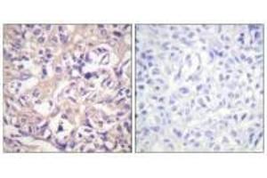 Immunohistochemistry analysis of paraffin-embedded human breast carcinoma tissue using TK (Ab-13) antibody. (TK1 anticorps  (Ser13))