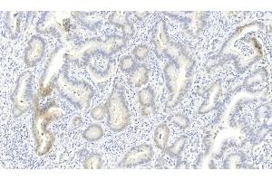 Immunohistochemical analysis of paraffin-embedded Human Lung adenocarcinoma section using Pink1 (ABIN6243980 and ABIN6577274). (ROS1 anticorps)