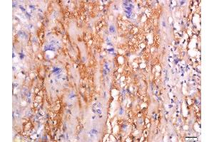 Formalin-fixed and paraffin embedded human colon carcinoma tissue labeled with Anti-sFRP-4 Polyclonal Antibody, Unconjugated  at 1:200 followed by conjugation to the secondary antibody and DAB staining. (SFRP4 anticorps  (AA 151-260))