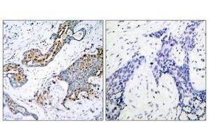 Immunohistochemical analysis of paraffin-embedded human breast carcinoma tissue using Estrogen Receptor-a(Phospho-Ser118) Antibody(left) or the same antibody preincubated with blocking peptide(right). (Estrogen Receptor alpha anticorps  (pSer118))