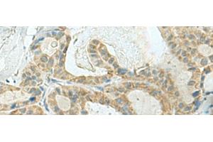 Immunohistochemistry of paraffin-embedded Human thyroid cancer tissue using KLC2 Polyclonal Antibody at dilution of 1:120(x200) (KLC2 anticorps)