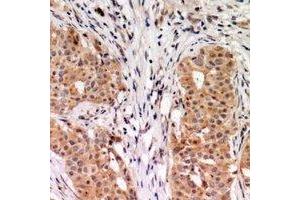 Immunohistochemical analysis of RhoGDI alpha staining in human breast cancer formalin fixed paraffin embedded tissue section. (ARHGDIA anticorps  (C-Term))