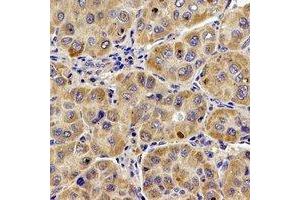 Immunohistochemical analysis of UQCR10 staining in human liver cancer formalin fixed paraffin embedded tissue section. (UQCR10 anticorps)