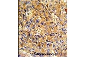 Formalin-fixed and paraffin-embedded human hepatocarcinoma with Cyclin A (CCNA2) Antibody (N-term), which was peroxidase-conjugated to the secondary antibody, followed by DAB staining. (Cyclin A anticorps  (N-Term))