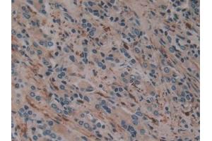 Detection of F13A1 in Human Prostate cancer Tissue using Polyclonal Antibody to Coagulation Factor XIII A1 Polypeptide (F13A1)