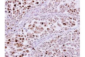 IHC-P Image karyopherin alpha 2 antibody [C3], C-term detects karyopherin alpha 2 protein at nucleus on human lung adenocarcinoma by immunohistochemical analysis.