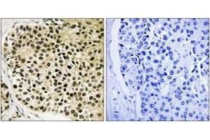 Immunohistochemistry analysis of paraffin-embedded human breast carcinoma, using NFAT3 (Phospho-Ser168+Ser170) Antibody. (NFATC4 anticorps  (pSer168))