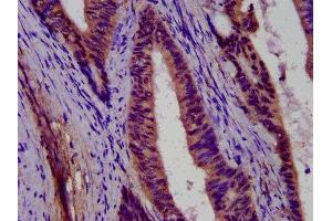 IHC image of ABIN7166555 diluted at 1:500 and staining in paraffin-embedded human colon cancer performed on a Leica BondTM system.