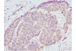 Immunohistochemistry of paraffin-embedded human gastric cancer using ABIN7151362 at dilution of 1:100 (ENOX2 anticorps  (AA 411-610))