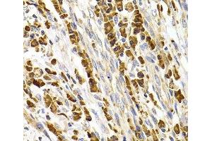 Immunohistochemistry of paraffin-embedded Human stomach cancer using TACR3 Polyclonal Antibody at dilution of 1:100 (40x lens). (TACR3 anticorps)
