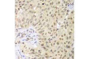 Immunohistochemistry of paraffin-embedded human oophoroma using LHX4 antibody at dilution of 1:100 (x400 lens). (LHX4 anticorps)