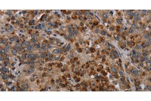 Immunohistochemistry of paraffin-embedded Human liver cancer using MAP3K11 Polyclonal Antibody at dilution of 1:40 (MAP3K11 anticorps)