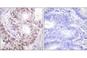 Immunohistochemistry analysis of paraffin-embedded human colon carcinoma, using CDC25C (Phospho-Thr48) Antibody. (CDC25C anticorps  (pThr48))