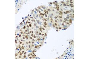 Immunohistochemistry of paraffin-embedded human lung cancer using MDC1 antibody at dilution of 1:100 (40x lens). (MDC1 anticorps)