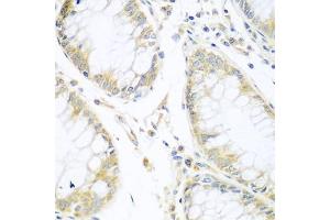 Immunohistochemistry of paraffin-embedded human gastric cancer using CUL3 antibody (ABIN5970436) at dilution of 1/100 (40x lens). (Cullin 3 anticorps)