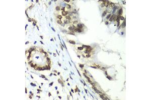 Immunohistochemistry of paraffin-embedded human liver cancer using TEAD1 antibody at dilution of 1:100 (x40 lens). (TEAD1 anticorps)