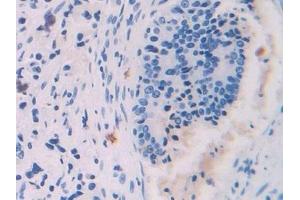 Detection of PF4 in Human Prostate cancer Tissue using Polyclonal Antibody to Platelet Factor 4 (PF4) (PF4 anticorps  (AA 31-101))