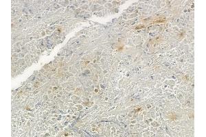 ABIN6266259 and ABIN6277418 at 1/100 staining human lung squamous cell carcinoma by IHC-P. (P2RY4 anticorps  (C-Term))