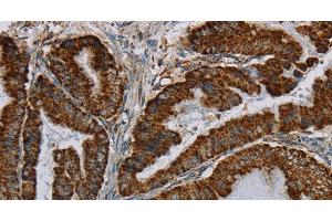 Immunohistochemistry of paraffin-embedded Human esophagus cancer using HSD17B2 Polyclonal Antibody at dilution of 1:50 (HSD17B2 anticorps)