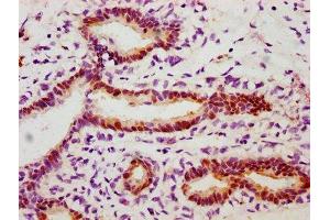 IHC image of ABIN7127700 diluted at 1:100 and staining in paraffin-embedded human breast cancer performed on a Leica BondTM system. (Recombinant HSP27 anticorps  (pSer78))