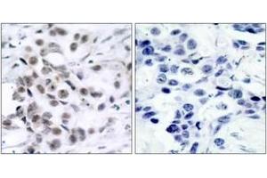 Immunohistochemistry analysis of paraffin-embedded human breast carcinoma tissue, using Chk1 (Ab-317) Antibody. (CHEK1 anticorps  (AA 286-335))