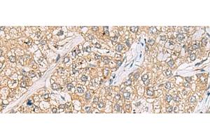 Immunohistochemistry of paraffin-embedded Human liver cancer tissue using P3H2 Polyclonal Antibody at dilution of 1:30(x200)