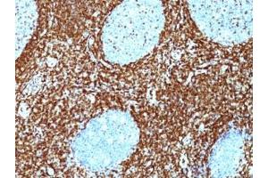 Formalin-fixed, paraffin-embedded human non-Hodgkin's lymphoma stained with Bcl-2 antibody (BCL2/782 + BCL2/796).