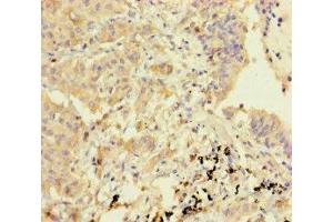 Immunohistochemistry of paraffin-embedded human lung cancer using ABIN7154785 at dilution of 1:100 (GBP6 anticorps  (AA 401-600))