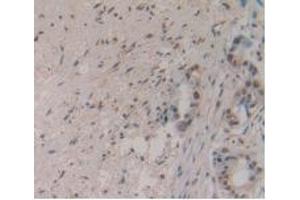 Detection of MSTN in Human Pancreas Cancer Tissue using Monoclonal Antibody to Myostatin (MSTN)