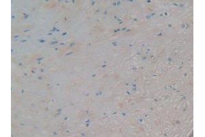 IHC-P analysis of Human Prostate Cancer Tissue, with DAB staining. (AZGP1 anticorps)