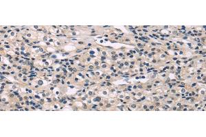 Immunohistochemistry of paraffin-embedded Human prostate cancer using MED28 Polyclonal Antibody at dilution of 1/30