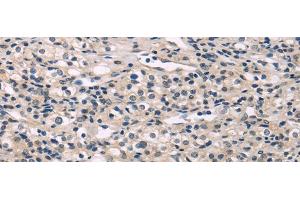 Immunohistochemistry of paraffin-embedded Human prostate cancer using MED28 Polyclonal Antibody at dilution of 1/30 (MED28 anticorps)