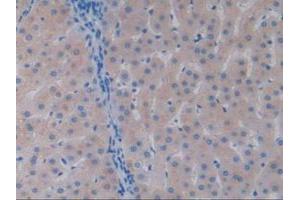 IHC-P analysis of Human Liver Cancer Tissue, with DAB staining.