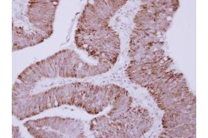 IHC-P Image Immunohistochemical analysis of paraffin-embedded human colon carcinoma, using OTC, antibody at 1:250 dilution.