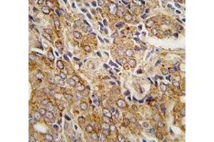 IHC analysis of FFPE human prostate carcinoma tissue stained with TRPM8 antibody (TRPM8 anticorps  (AA 926-956))
