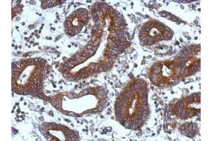 IHC-P Image Immunohistochemical analysis of paraffin-embedded human colon carcinoma, using TIE1, antibody at 1:500 dilution. (TIE1 anticorps)
