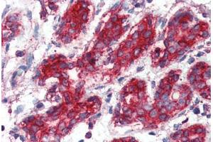 Human Breast (formalin-fixed, paraffin-embedded) stained with SOD2 antibody ABIN396955 at 1:50 followed by biotinylated anti-mouse IgG secondary antibody ABIN481714, alkaline phosphatase-streptavidin and chromogen. (SOD2 anticorps)