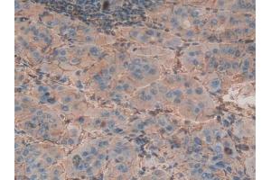 Detection of b2M in Human Liver cancer Tissue using Polyclonal Antibody to Beta-2-Microglobulin (b2M)