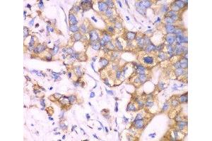 Immunohistochemistry of paraffin-embedded Human liver cancer using RPS3A Polyclonal Antibody at dilution of 1:100 (40x lens). (RPS3A anticorps)