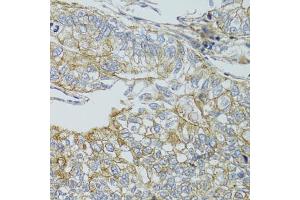 Immunohistochemistry of paraffin-embedded human gastric cancer using CHMP4B antibody (ABIN4903276) at dilution of 1:100 (40x lens).