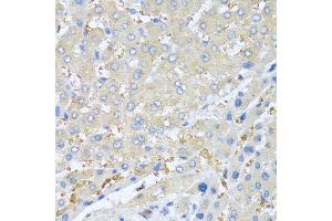 Immunohistochemistry of paraffin-embedded human liver cancer using PPBP antibody at dilution of 1:100 (40x lens). (CXCL7 anticorps)