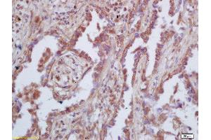 Formalin-fixed and paraffin embedded human lung carcinoma  labeled with Rabbit Anti-GAS 6 Polyclonal Antibody, Unconjugated (ABIN873146) at 1:200 followed by conjugation to the secondary antibody and DAB staining