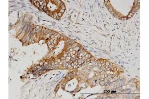 Immunoperoxidase of monoclonal antibody to SERBP1 on formalin-fixed paraffin-embedded human pancreatic cancer. (SERBP1 anticorps  (AA 1-402))